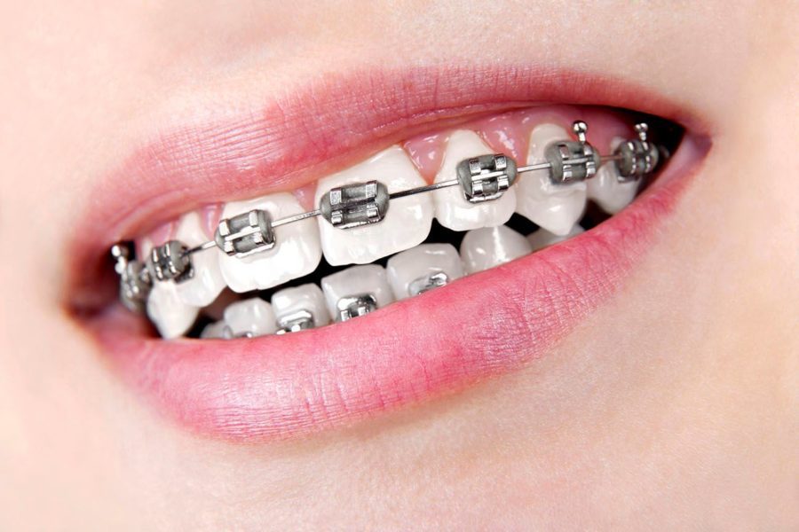 The History Of Braces - Cosmetic Dentist In Columbia, MD